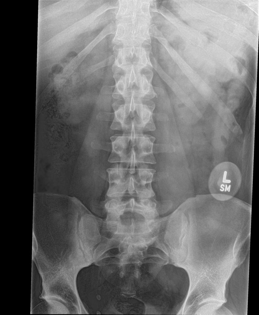 normal ap cervical spine x ray